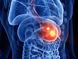 gastric cancer